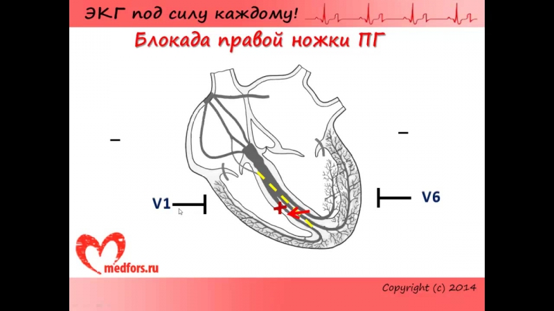 [7 экг под силу каждому] блокады, часть 2 блокады ножек пучка гиса