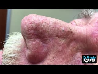 Чистка пор на носу и черные точки в морщинах на лбу