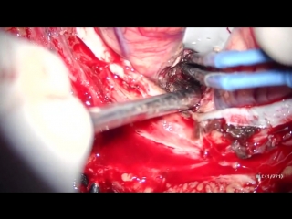 27 удаление опухоли головного мозга (метастаза в левую теменную долю)