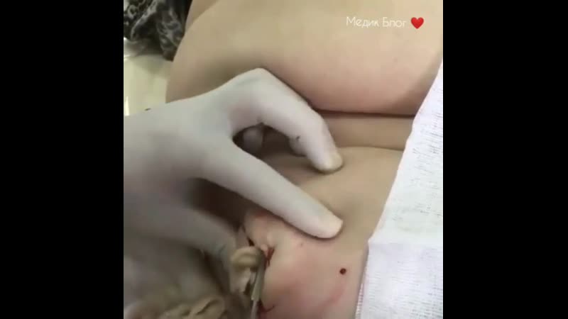 Нагноившаяся атерома бедра 🙊