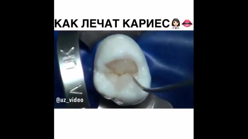Как лечат кариес профессионалы