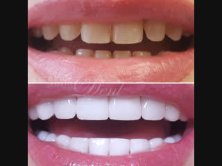 Perfect smile veneers дарят привлекательную белоснежную улыбку! (1)