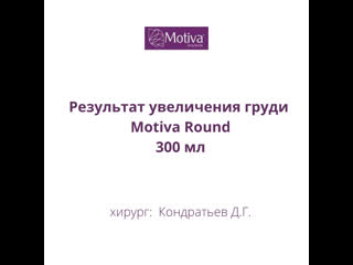 Результат увеличения груди круглыми имплантами motiva объемом 300 мл