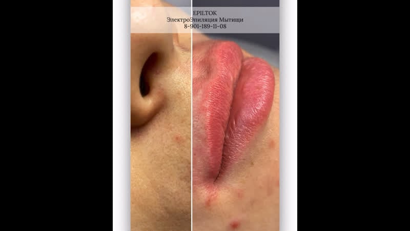 Видео верхняя губа, полное удаление за 3 сеанса