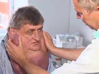 Мужчине удалили опухоль с лица весом в 6 кг