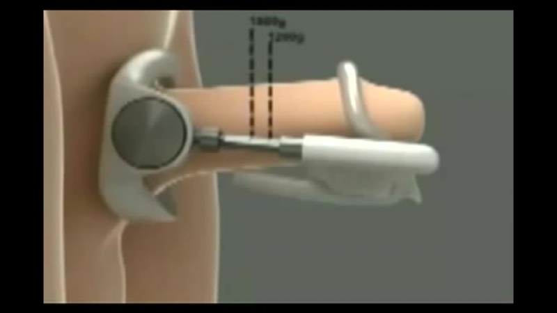 Экстендер proextender увеличение пениса без операции