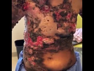 Пациент проходит лечение с распространенным раком молочной железы, который распространился на кожу