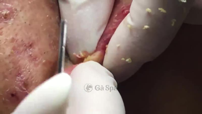 Чистка пор, угри, черные точки