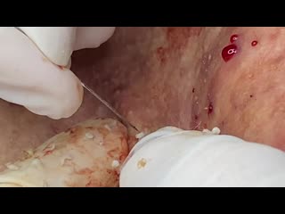 "тысяча выдавливаний" сезон 2, серия 2 из 3