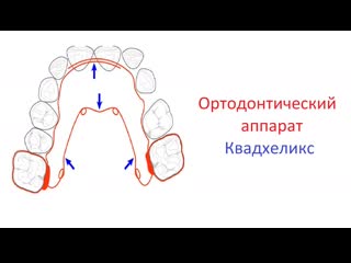 Ортодонтический аппарат квадхеликс (quad helix) принцип действия, активация