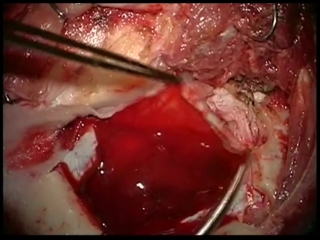 6 операция удаление субдуральной гематомы и клипирование аневризмы зса