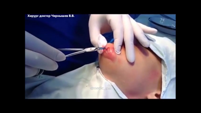 Абсцедирующий фурункул подбородка