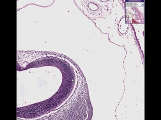 Fallopian tube ectopic pregnancy with embryo