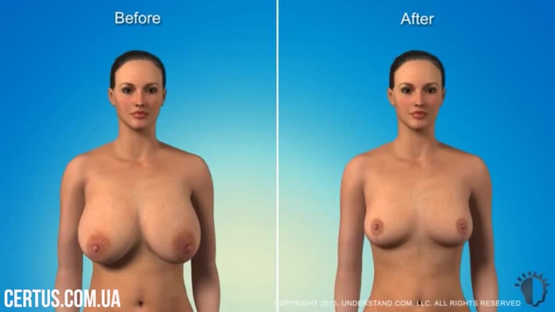 Уменьшение груди редукционная маммопластика уменьшение груди