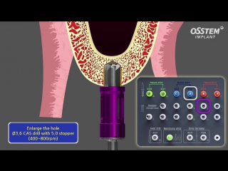 Hiossen osstem cas kit [crestal approuch sinus lifting kit]