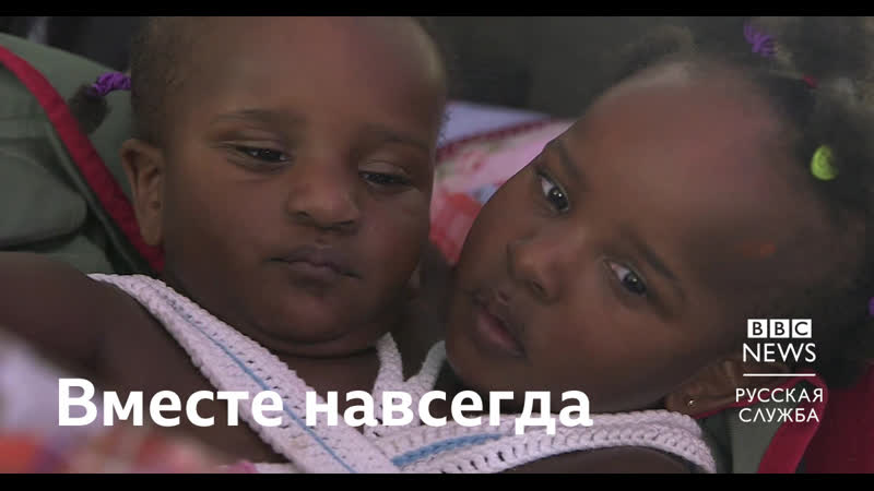 История сиамских близнецов, которых нельзя разделить