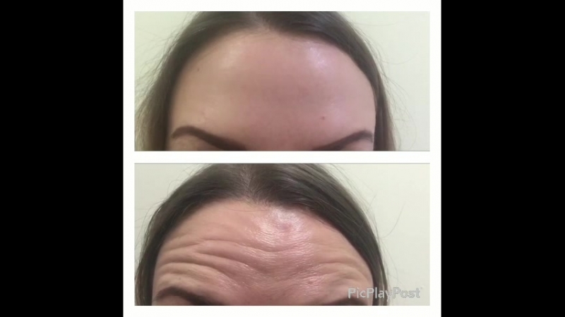 Эффект от ботокса