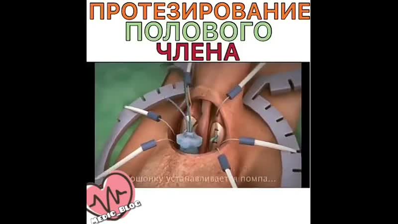 Протезирование полового члена