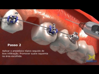 Mini implante morelliустаноа миниимплантаортодонтия [360]