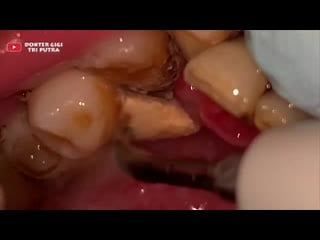 Снятие зубного камня