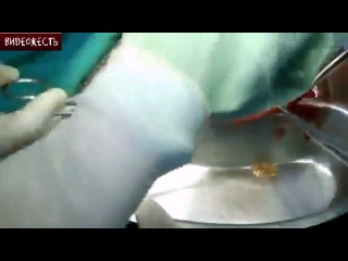 Эхинококкоз печени не для слабонервных © видеожесть