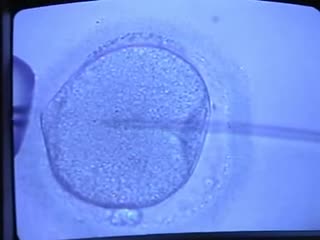 In vitro fertilization (ivf) procedure (part 3)