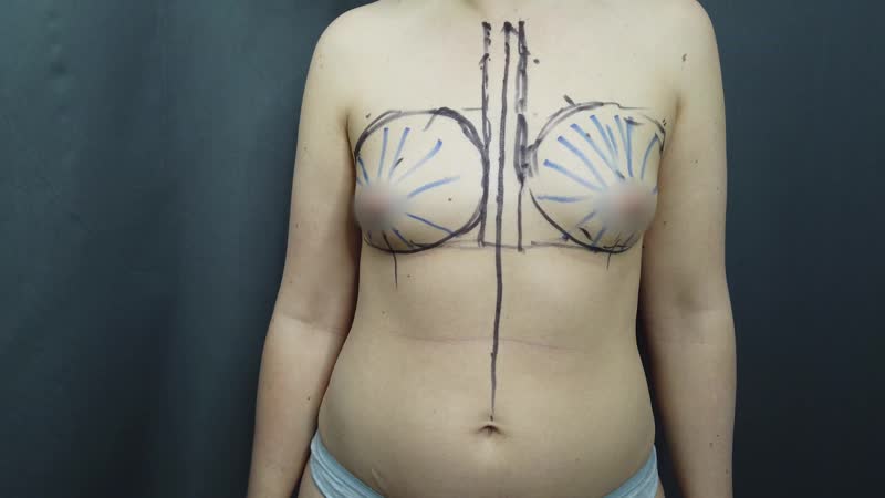 Разметка перед липофилингом груди