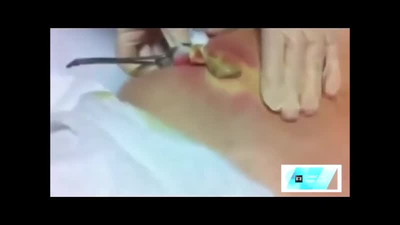 Вскрытие абсцесса