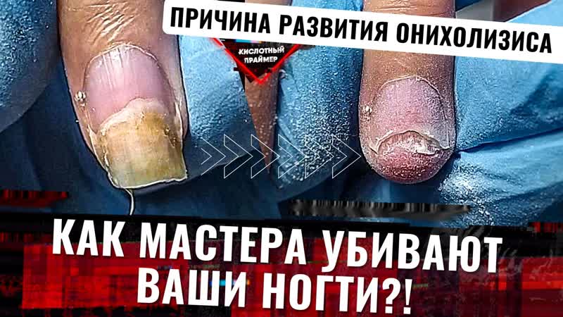 Пришла клиентка, а там😱😱 жесткий онихолизис ногтей‼️