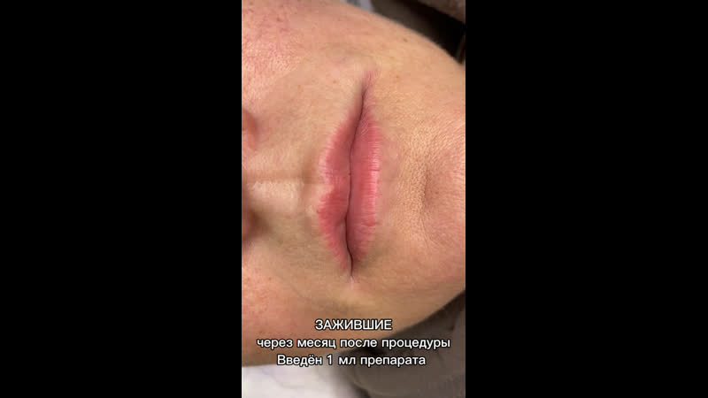 Аугментация губ (сложная форма)