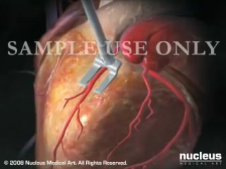 Heart bypass surgery cabg