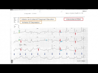 Ecg case 1 chest pain in heavy smoker