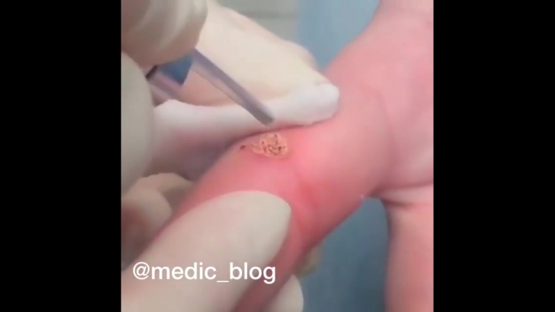 Лазерное удаление бородаи