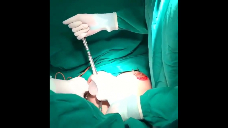 Грудные имплантанты