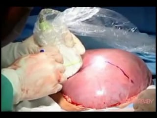 Open uterys surgery for bifid spine