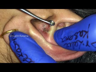 Черные точки в ушах от kasana