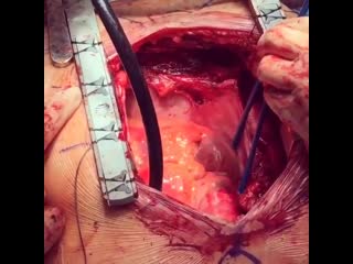 Мерцательная аритмия