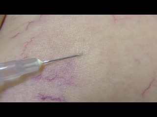 Eliminating spider veins with a solution called sclerosant, which causes the vein to almost immediately collapse, leading to rea