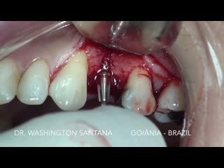 Esthetic dental implant with guide bone regeneration (gbr) and soft tissue graft