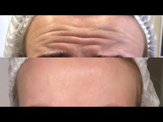 Ботулинотерапия в действии