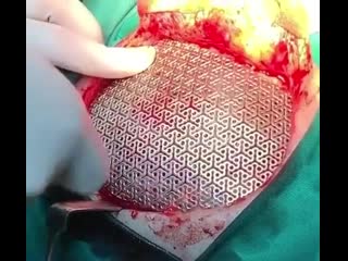 Протезирование костей черепа