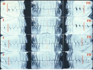 Occlusion plane introduction and measurements японский ролик