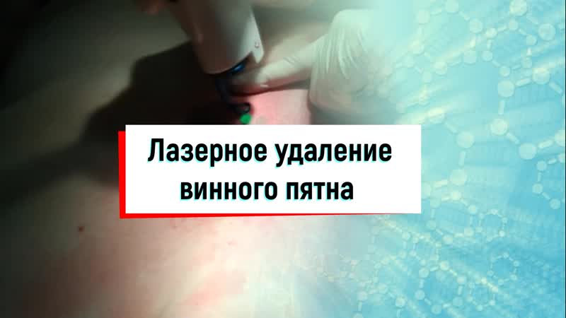 Лазерное удаление винного пятна