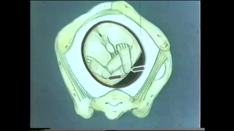 Роды при тазовом предлежании плода © breech presentation of the fetus