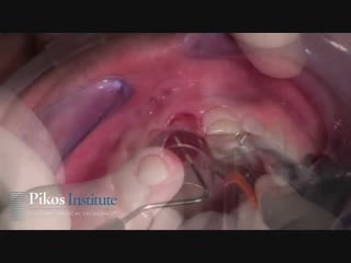 Pikos implant institute soft tissue grafting