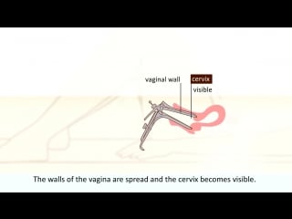 A cervical screening test what can you expect