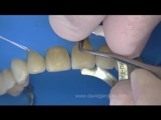 Dental dam and ceramic veneers part 2 clamps and ligatures