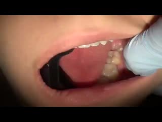 Удаление зуба мудрости removal of wisdom teeth (360p) mp4