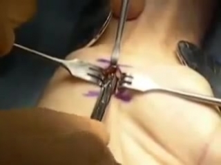 54 декомпрессия срединного нерва (карпальный синдром) 1