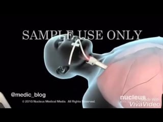 Интубация трахеи